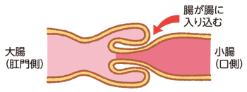 イラスト：腸重積症（腸が閉塞状態になっている様子）